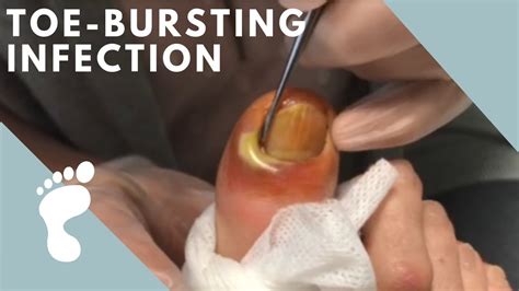 pussing videos|THE BEST POPPING, PUS, OOZING AND SPEWING VIDEOS .